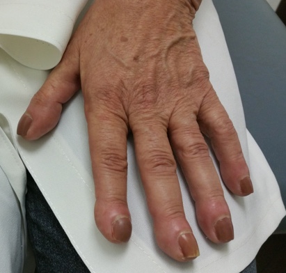 Clubbing or Widening of the Fingertips, ILD Symptoms